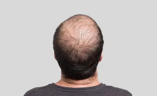 Yonsei University researchers discovered a ‘hair loss treatment’ from grain seed extract.