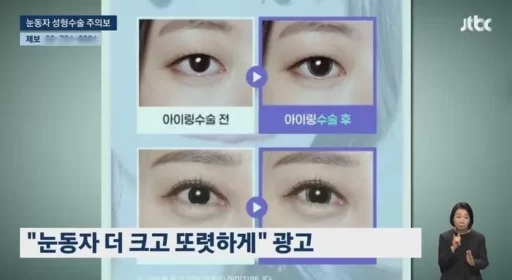 “Even Without Contact Lenses, Big and Clear… The Trending ‘Iris Surgery’ That Could Cause Vision Loss”