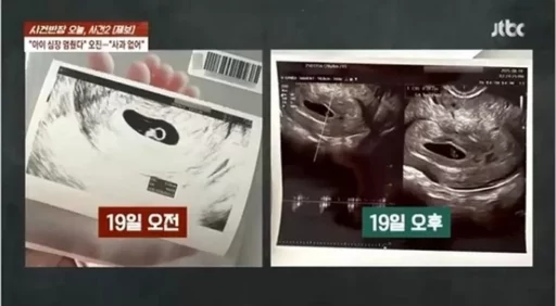 The obstetrician who suggested removing the fetal sac, claiming the “heart isn’t beating” in a living fetus… it was an unprecedented ‘misdiagnosis’.